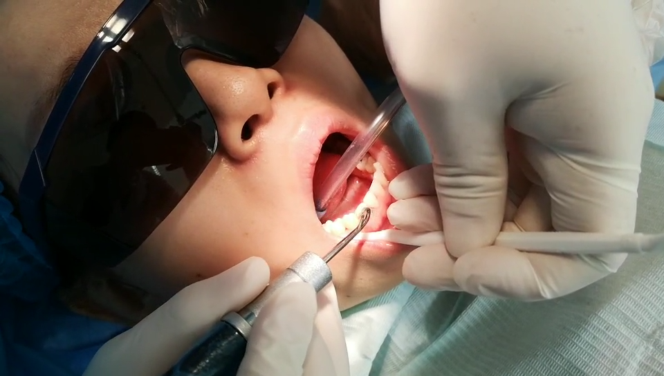 洗牙会得艾滋病和乙肝吗? 洗牙会得艾滋病和乙肝吗?